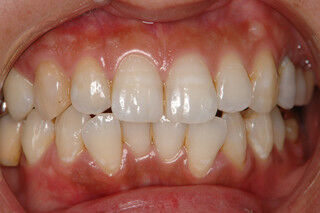 その白い歯、「隠れ虫歯」かもしれない!　どうすれば自分でケアできる?