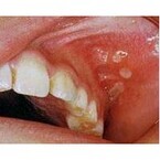 【コブスくんのモテ男道！】歯科医が教える。口内炎を早く治す方法