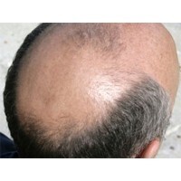 【エンタメCOBS】女性は男性のハゲを気にする？