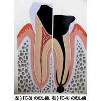 【コブスくんのモテ男道！】歯科医に聞く。むし歯の「C-4」ってなに？