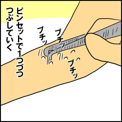 単なる水いぼかと思ったら 高熱が出て入院 夏の感染症にも気が抜けなかった 16年7月28日 ウーマンエキサイト 1 2