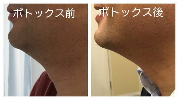 首をキレイにする方法（医療編）