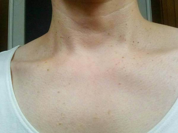 首をキレイにする方法（医療編）