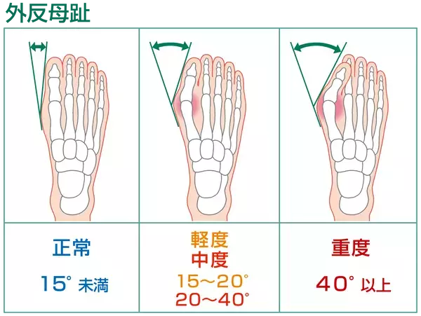 外反母趾＝幅広靴がいい。その考えは捨ててください