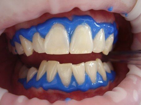 Laser teeth whitening 716468 340