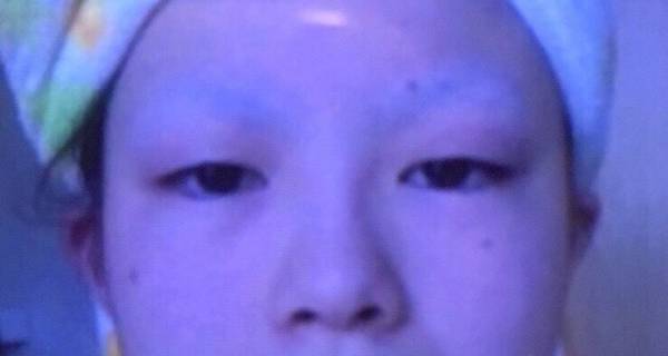 初めての整形手術。「三点留め埋没法」で二重まぶたにした話