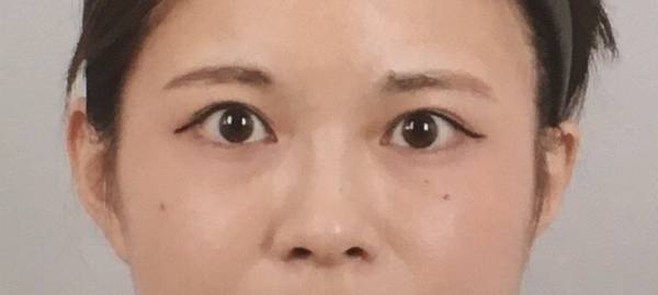 初めての整形手術。「三点留め埋没法」で二重まぶたにした話