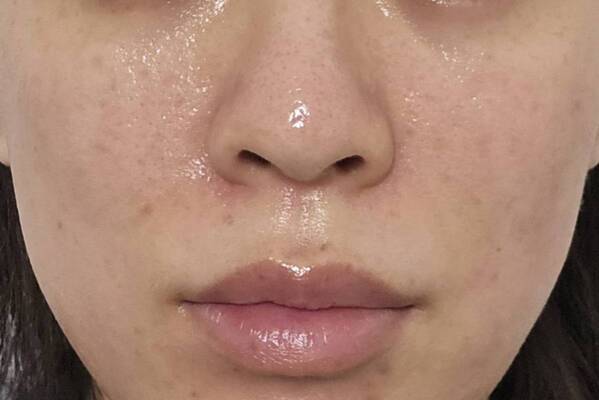 美容医療好きライターが話題の美容施術“キュアジェット”を体験！