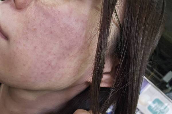 美容医療好きライターが話題の美容施術“キュアジェット”を体験！