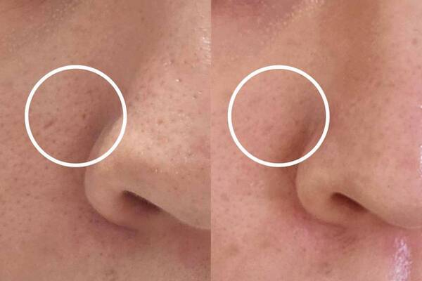 美容医療好きライターが話題の美容施術“キュアジェット”を体験！