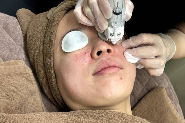 美容医療好きライターが話題の美容施術“キュアジェット”を体験！