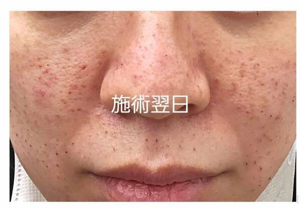 美容医療好きライターが話題の美容施術“キュアジェット”を体験！