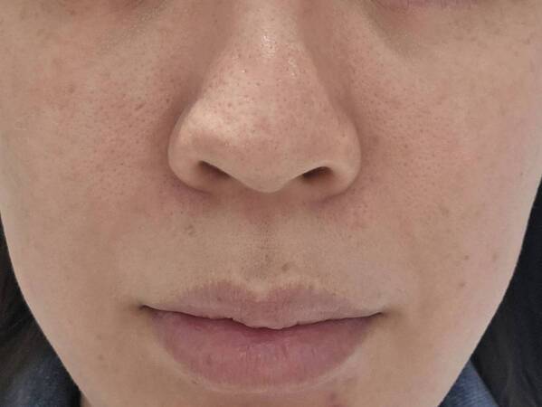 美容医療好きライターが話題の美容施術“キュアジェット”を体験！