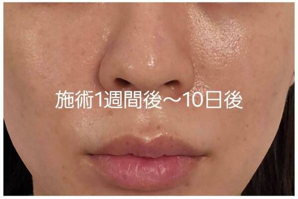 美容医療好きライターが話題の美容施術“キュアジェット”を体験！