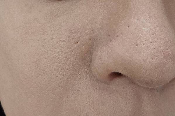 美容医療好きライターが話題の美容施術“キュアジェット”を体験！