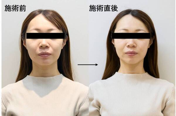 垢抜けたいアラサー編集部員が美容医療を3つ受けてみた。痛み・ダウンタイム・即効性をガチ採点