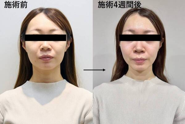 【4週間後の衝撃】アラサー編集部員が美容医療を受けた結果……「痩せた？」と言われるようになった話