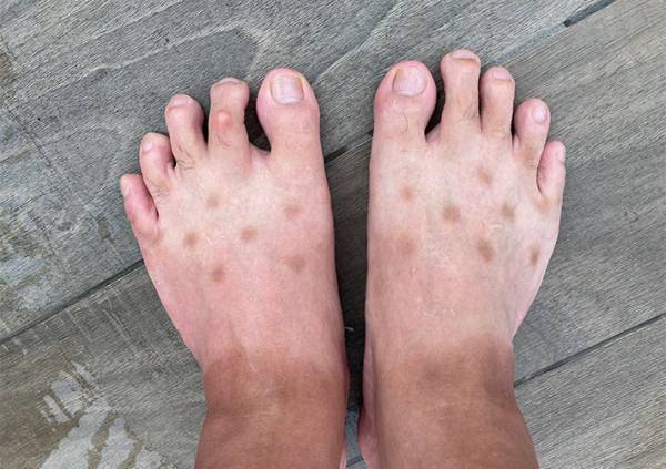足に謎の斑点ができた男性　判明したまさかの原因とは？　「笑った」「同じ経験ある」