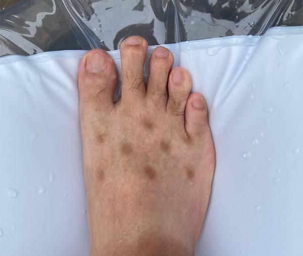 足に謎の斑点ができた男性　判明したまさかの原因とは？　「笑った」「同じ経験ある」