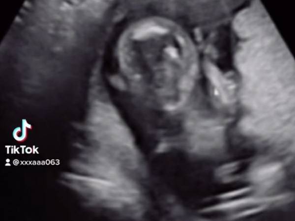 エコー検査でピースをしていた娘　誕生してから写真を撮ると？