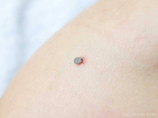 感染症で死亡例も　マダニに咬まれた時に『絶対やってはいけないこと』とは