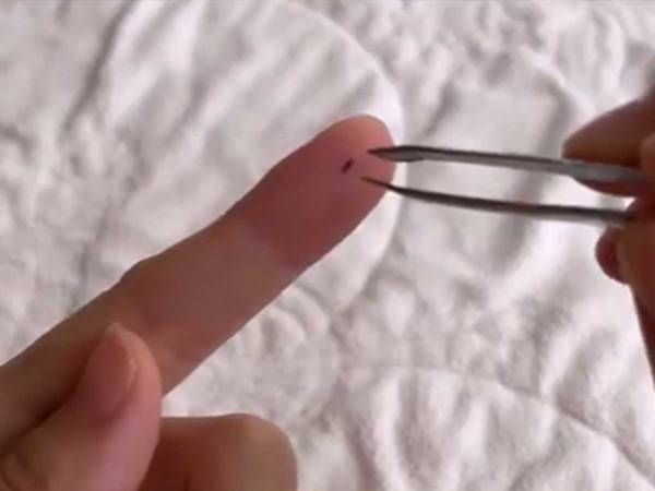 指に刺さった『小さなトゲ』にイラッ　あるアイテムを使うと？　「コレはいい方法」