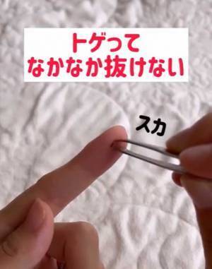 指に刺さった『小さなトゲ』にイラッ　あるアイテムを使うと？　「コレはいい方法」
