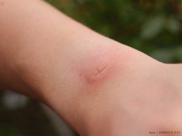 蚊に刺された時に『バツ印』を付けるといい？　専門家に聞いてみたら…　「過去の自分に教えたい」