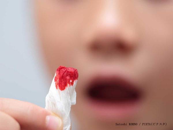 消防局「ティッシュはつめないで！」　鼻血が出た時の正しい３つの対処法