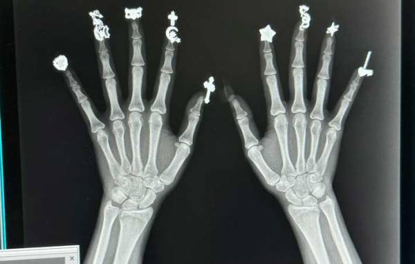 レントゲン写真に『１０万いいね』　写り込んでいたものに「笑った」「斬新すぎる」