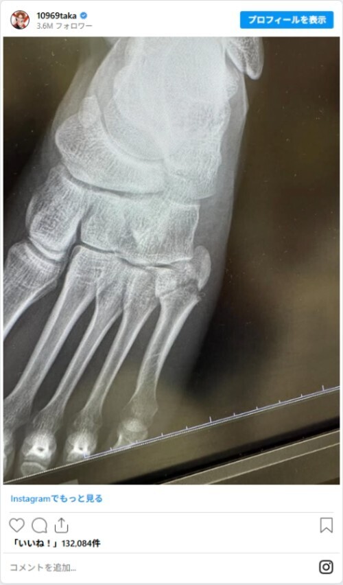 【心配】「ものすごい勢いで…」　ワンオク・Takaがライブ中に左足を骨折、ファンからは？