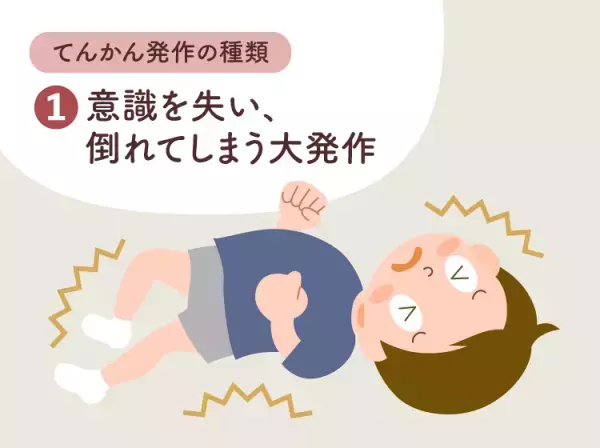 てんかん（癲癇）とは？原因や発作のパターンをイラストで詳しく解説。4つの診断の種類なども【医師監修】