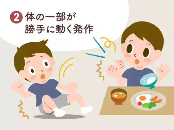 てんかん（癲癇）とは？原因や発作のパターンをイラストで詳しく解説。4つの診断の種類なども【医師監修】