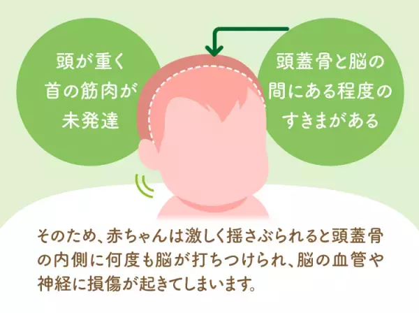 乳幼児揺さぶられ症候群（揺さぶられっ子症候群・SBS）とは？何歳まで注意が必要？症状や原因、後遺症についてマンガで解説【医師監修】