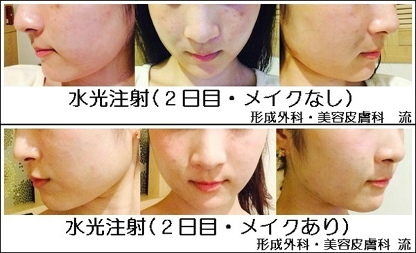 韓国女子のような「うるツヤ肌」を手に入れる！水光注射体験レポ