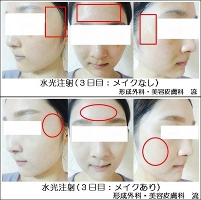韓国女子のような「うるツヤ肌」を手に入れる！水光注射体験レポ