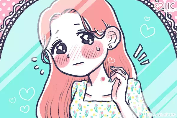 キスマークの消し方10選！7つの隠し方と言い訳の仕方も紹介