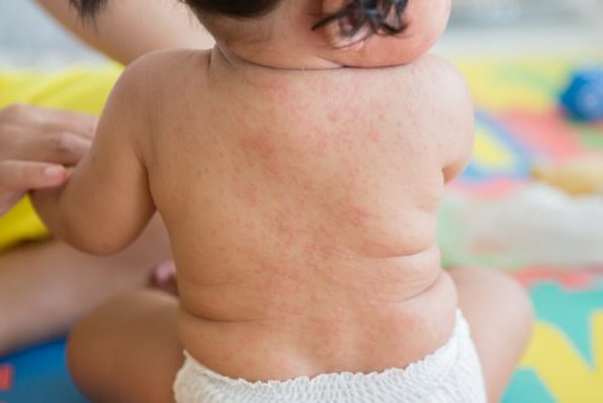 ママ 見分けられる あせもと湿疹 の違いと原因 16年6月23日 ウーマンエキサイト 1 2