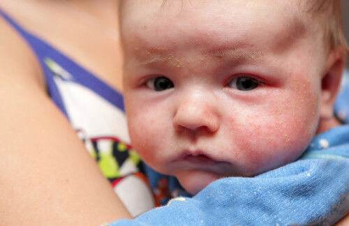 アトピーの可能性もアリ 乳児脂漏性湿疹 と他の病気の違い 16年11月23日 ウーマンエキサイト 1 2