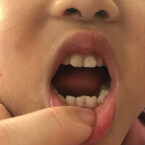 【歯科医Q＆A】くっついて生える「癒合歯」、 原因と永久歯への影響は？