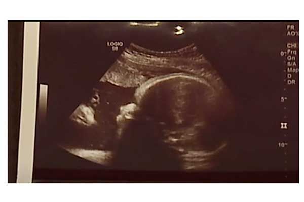 胎児エコー写真に写っていた驚きのモノとは 17年8月24日 ウーマンエキサイト