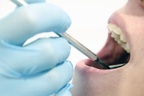 隙間から虫歯にも…歯周病も引き起こす“ズレた銀歯”の恐怖