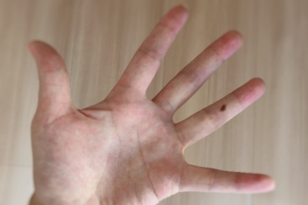 手の甲のホクロは腸の不調のサイン…お血でわかる病気のサイン
