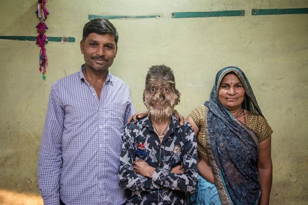 発毛剤入り胃薬を飲んだ赤ちゃん「狼男症候群」に