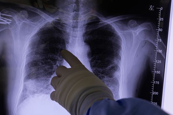 「高熱なのに汗をかかない」コロナ発症者が明かす意外な症状