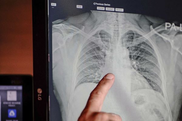 コロナ症状は10日目前後に注意　基礎疾患なしで両肺重篤化も