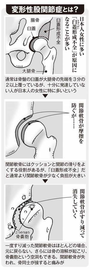 急に激痛が…40以降の女性に多い「変形性股関節症」とは