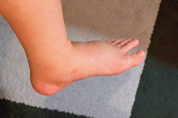 顔も足もパンパン！年末年始の食べすぎ飲みすぎ、運動しなさすぎによる「むくみ」には「すねグルグル押し」