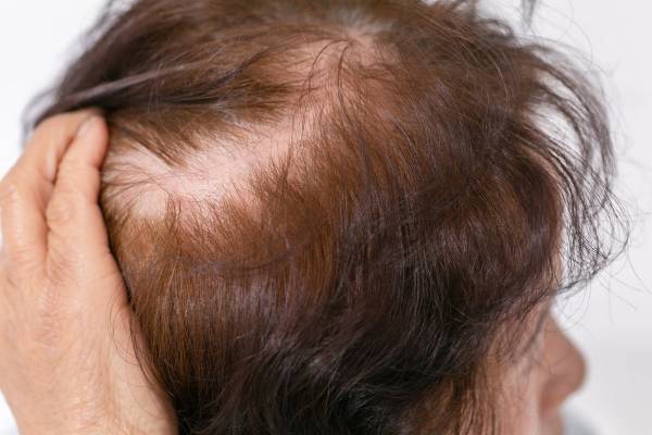 “抜ける”3大原因は「貧血」｢血行不良｣｢ホルモン減少｣めまい、腰痛、耳鳴り…不調でわかる「薄毛対策」