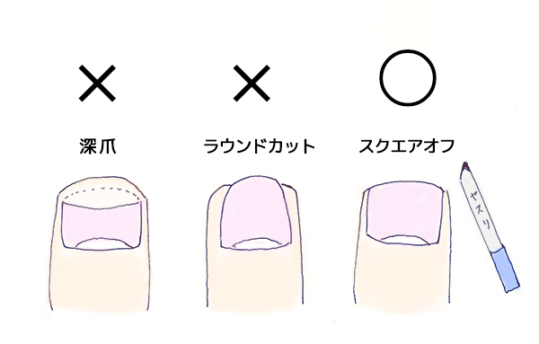 加齢で悪化する？！巻き爪の正しいお手入れ